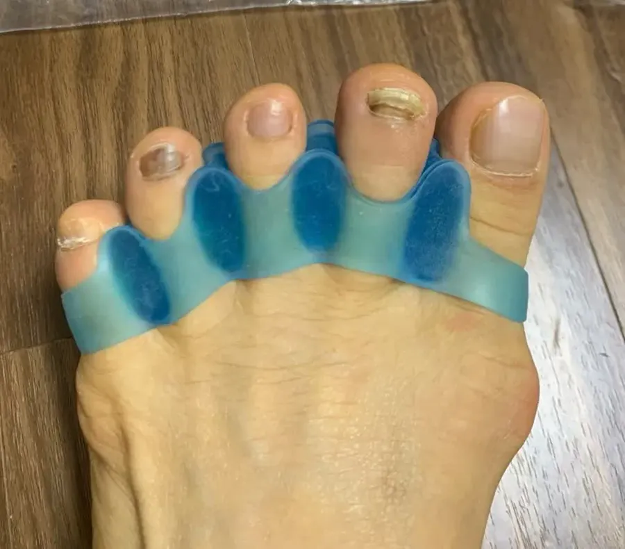 Gel toe spacers photographed by Dana K., a verified buyer